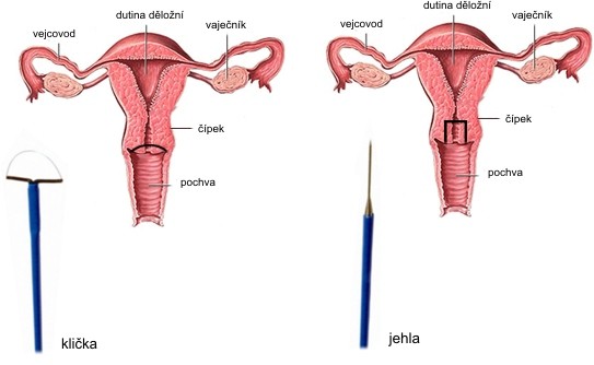hpv vírus a tehotenstvi